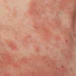 eczema-example-1