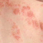 eczema-example-2