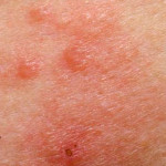 eczema-example-3