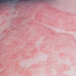 eczema-example-4