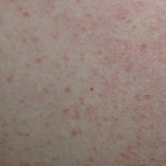 eczema-example-5